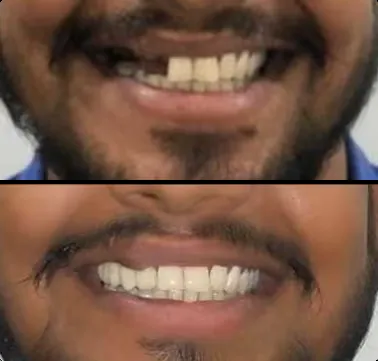 implant_before_after_1-converted-from-png