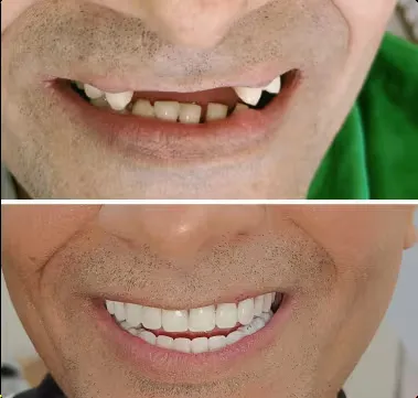 implant_before_after_3-converted-from-png